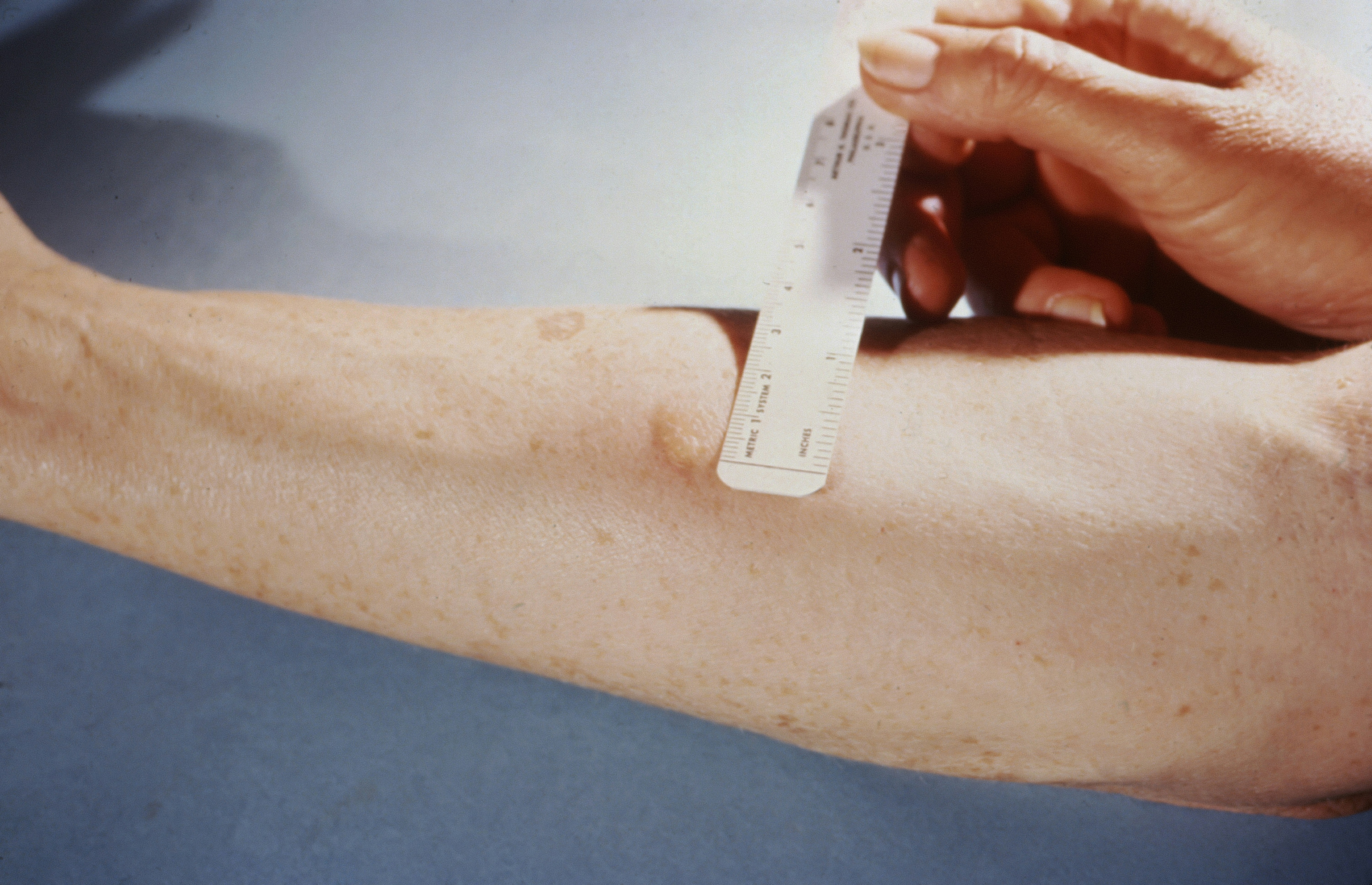This patient presented with a positive reaction to the 48-hour Mantoux skin test. The Mantoux skin test is given with a needle and syringe, used to inject testing fluid, called tuberculin, between the layers of the skin, usually on the volar surface of the forearm, as was the case here. The injection site becomes hard, or indurated, and red, in a person who is infected with tuberculosis.
